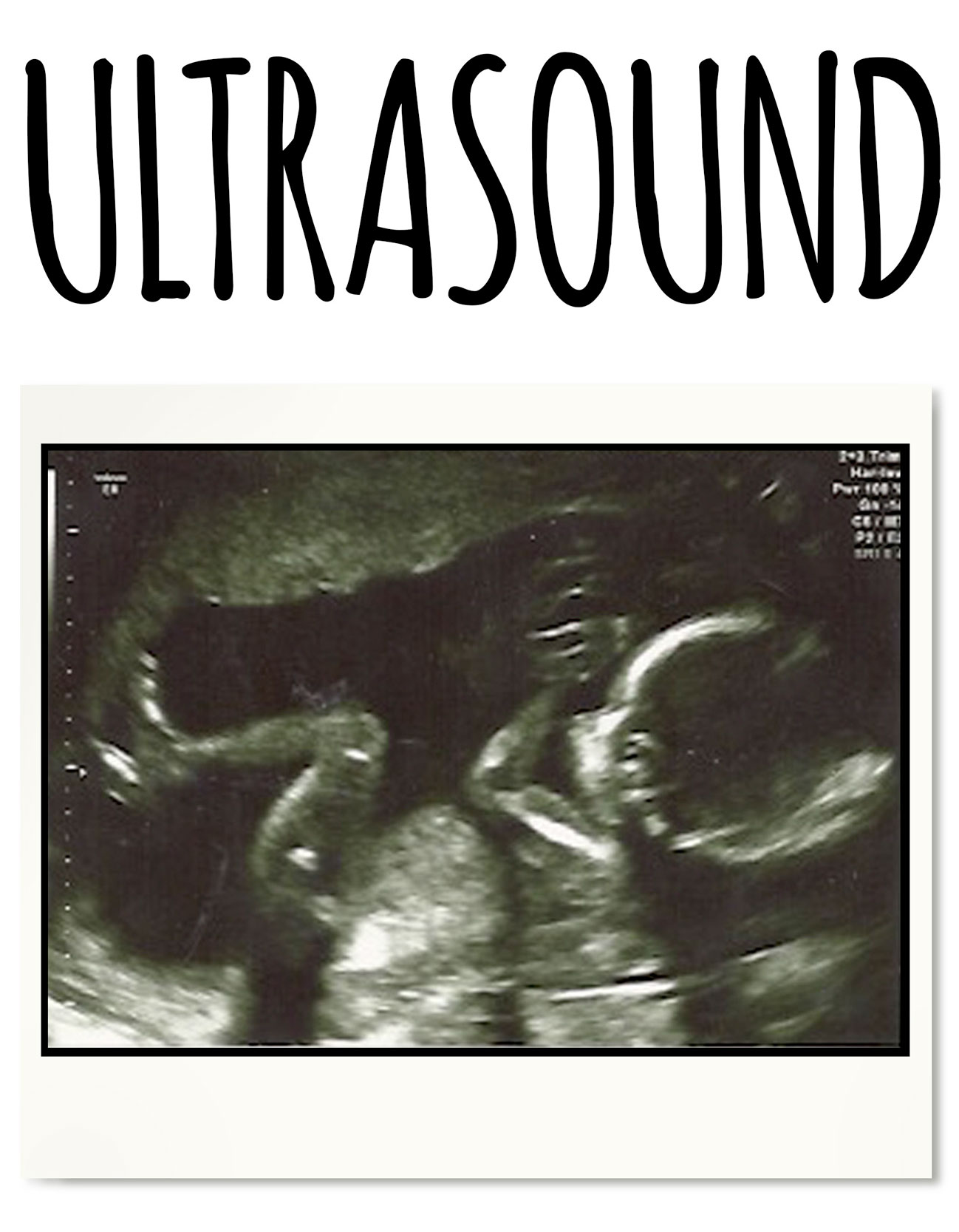 home-post-01.jpg Ultrasons, ultrasound, grossesse, enceinte, avortement